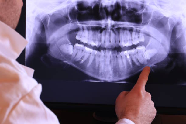 Best Knocked-Out Tooth (Avulsed Tooth) Treatment in Shady Hills, FL